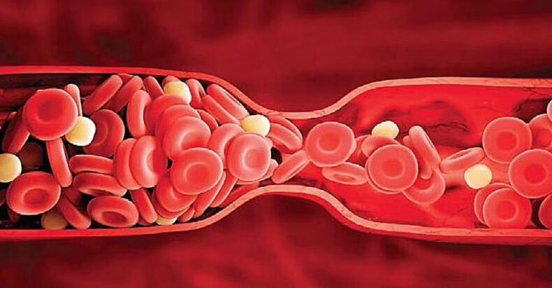 New Study: Blood Clotting Is The Root Cause Of Long Covid Syndrome