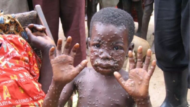 WHO says Monkeypox cases confirmed in 12 countries 