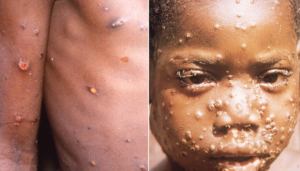 Kerala reports the case of Monkeypox again