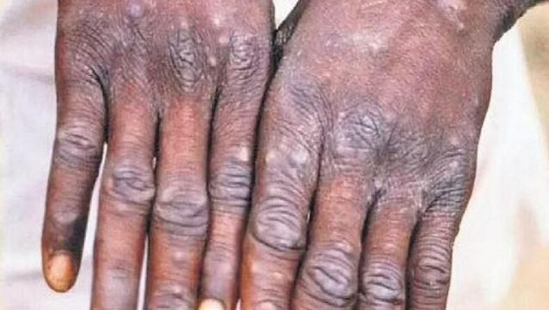 Monkeypox A.2 strain detected in India: All you need to know