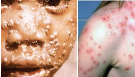 Difference between Monkeypox and Chickenpox | Explained