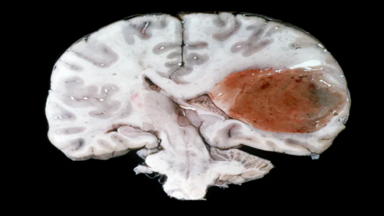 Scientists find a new to restrict the spread of brain cancer