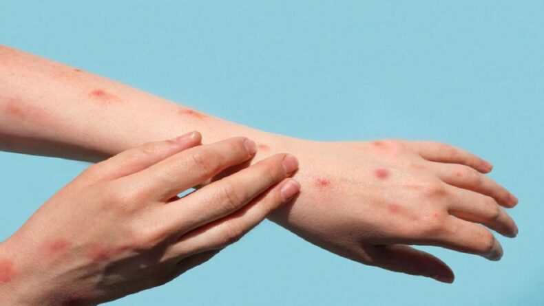 Pointers to differentiate Monkeypox rashes from other forms of rashes on your skin