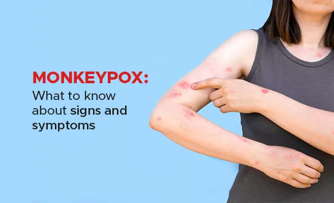 Pointers to differentiate Monkeypox rashes from other forms of rashes on your skin - Asiana Times