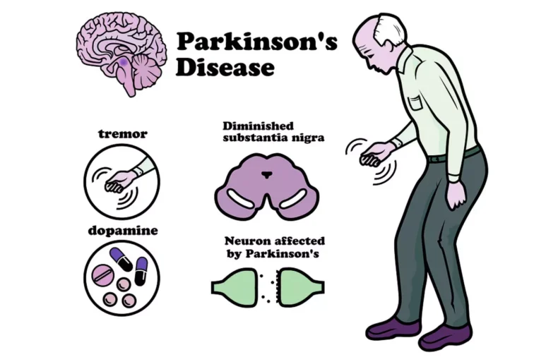 The AI for disease analysis: The Parkinson’s disease edition - Asiana Times