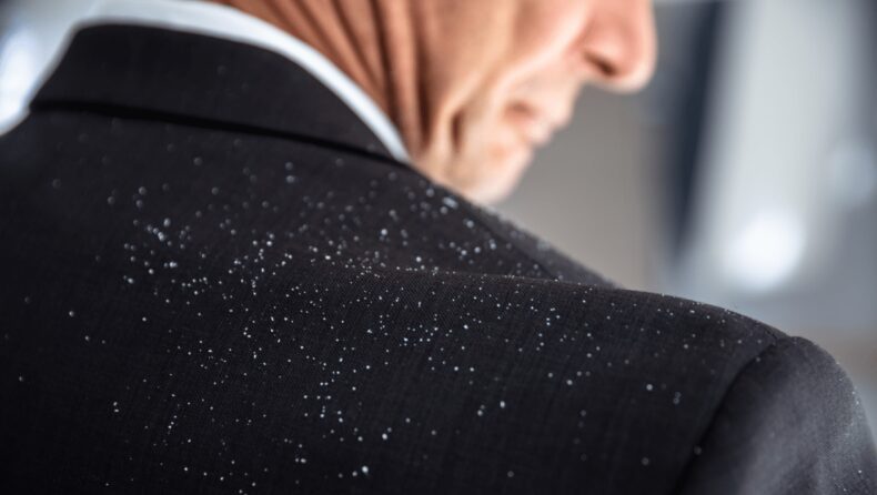 4 Bad Habits That Are Giving You Dandruff
