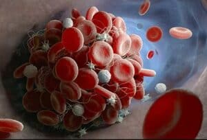 thrombosis-and-its-impact-on-our-body