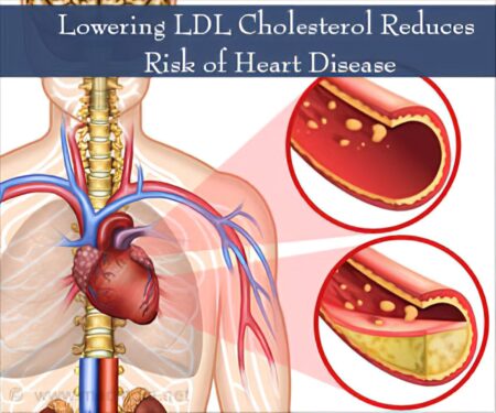 People with high cholesterol should be cautious regarding heart disease - Asiana Times