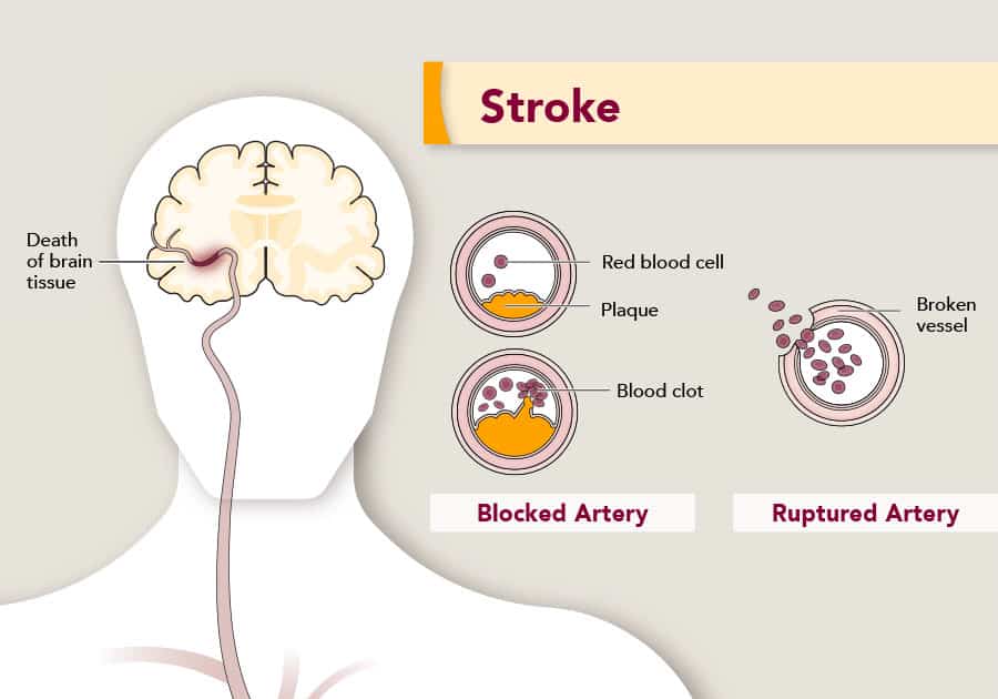 Precious Time as Minutes can Save Lives: World Stroke Day 2022 - Asiana Times