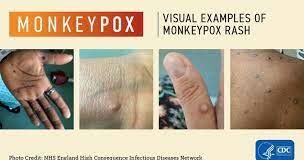 WHO reports Monkeypox as a global health emergency - Asiana Times