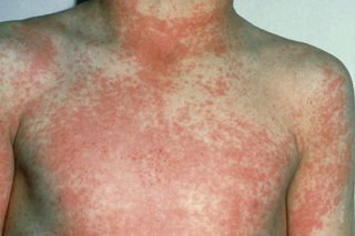 "Swift rise" in Scarlet Fever scare in the UK - Asiana Times