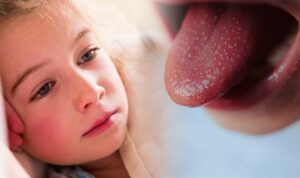 contagious disease, scarlet fever, rise in uk, victorian disease, scarlet fever rash, scarlet fever treatment, COVID protocol, streptococcus, strep throat, scarlatina, scarlet fever treatment, antibiotics, pediatricians, general practitioners, high fever in kids in uk, high fever, airborne,hygienic practice, health scare in uk,