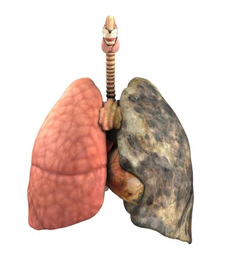 copd, lung disorder, respiratory disease