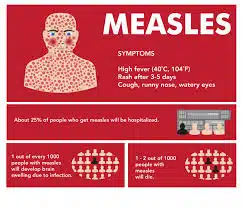 Measles: 7 death cases hit Bombay since September - Asiana Times