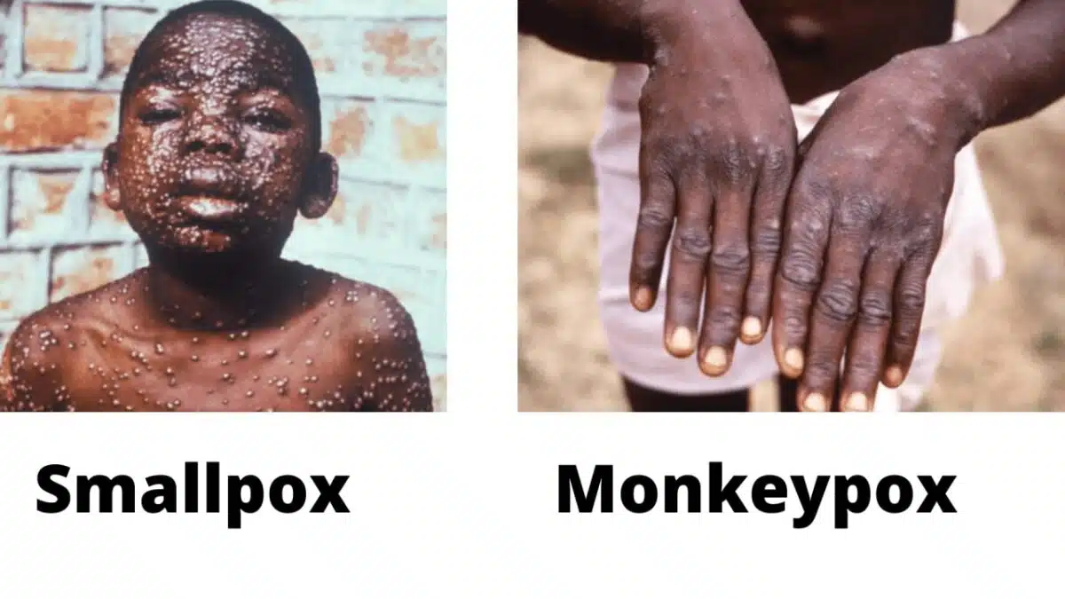 WHO reports Monkeypox as a global health emergency - Asiana Times