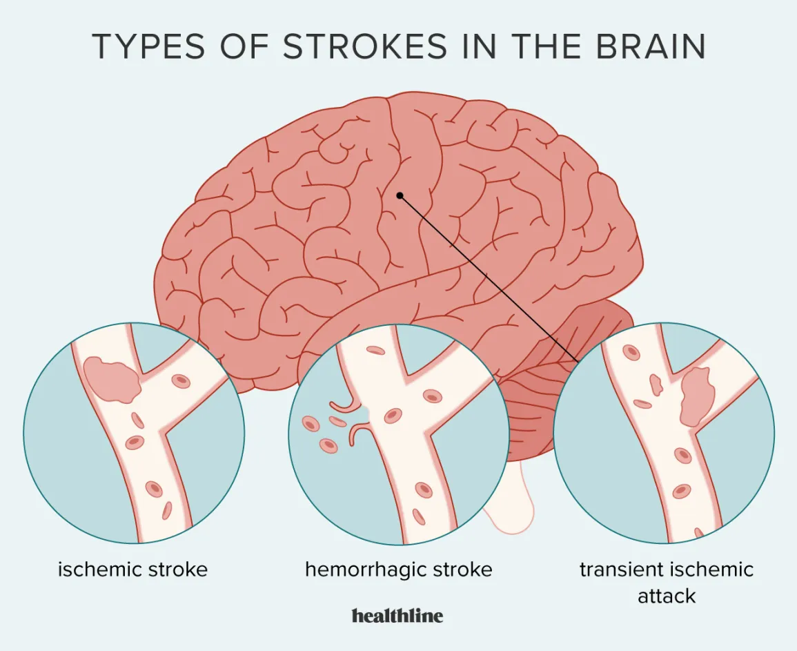brain stroke