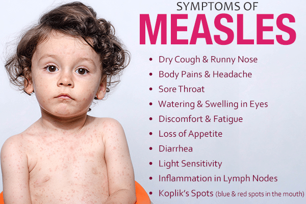 Mumbai measles outbreak: Why children are at risk? what are symptoms, vaccination, and treatment process? - Asiana Times