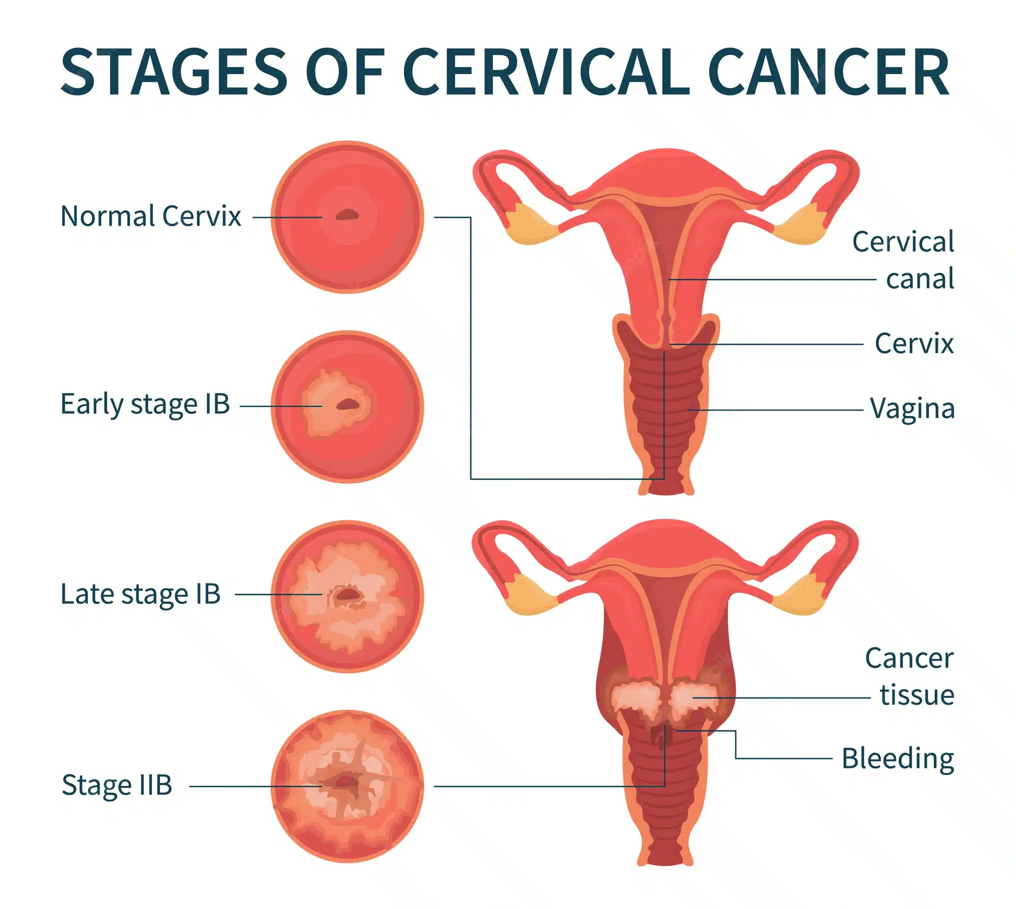 A Guide to Cervical Cancer and its Diagnosis - Asiana Times