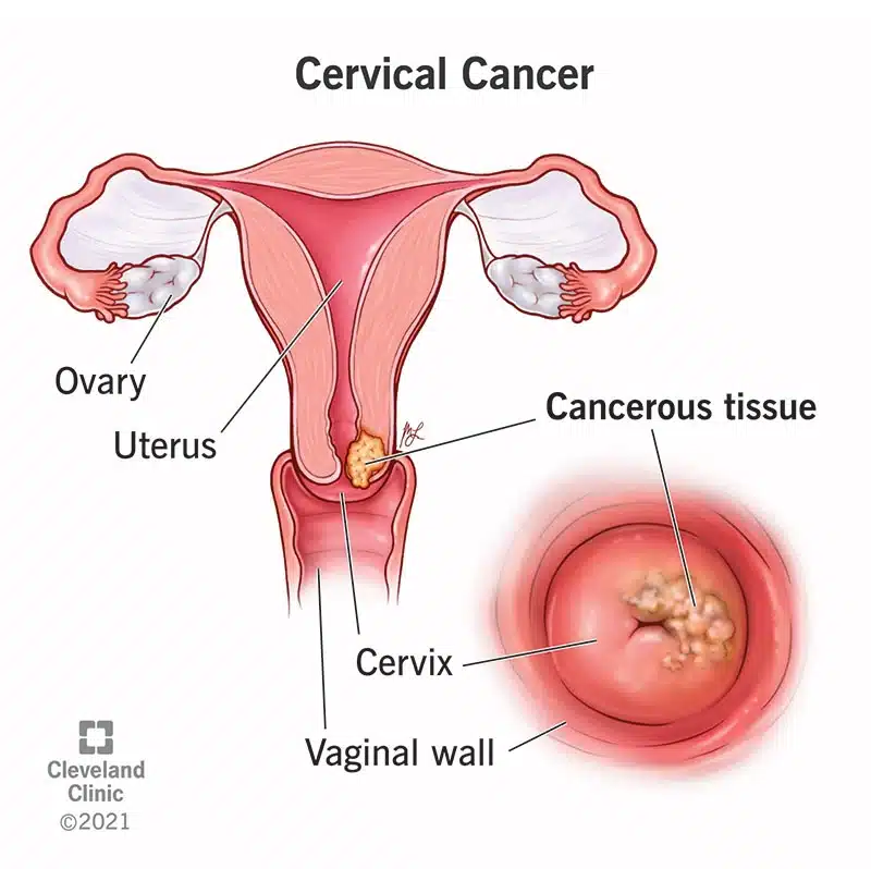 Cervical Cancer Signs And Symptoms Types And Diagnosis 