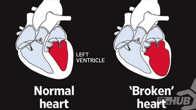 Broken Heart Syndrome: What is Its Cause? 
