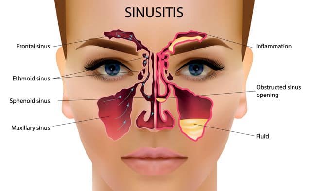 sinusitis in a women