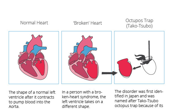 heart disorders
