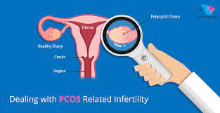 PCOS Infertility