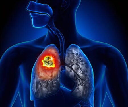 Pollution A Cause Of Lung Cancer: Save Your Lives - Asiana Times