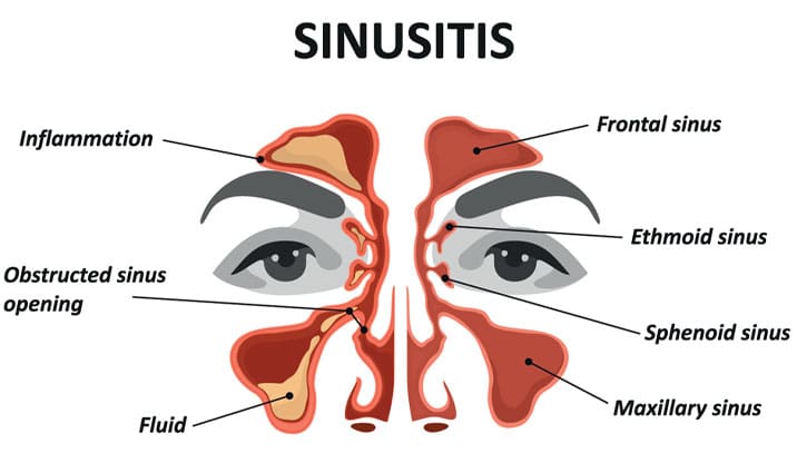 types of sinusitis