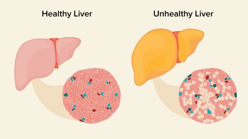 Several Life-Threatening Diseases due to Fatty liver. - Asiana Times