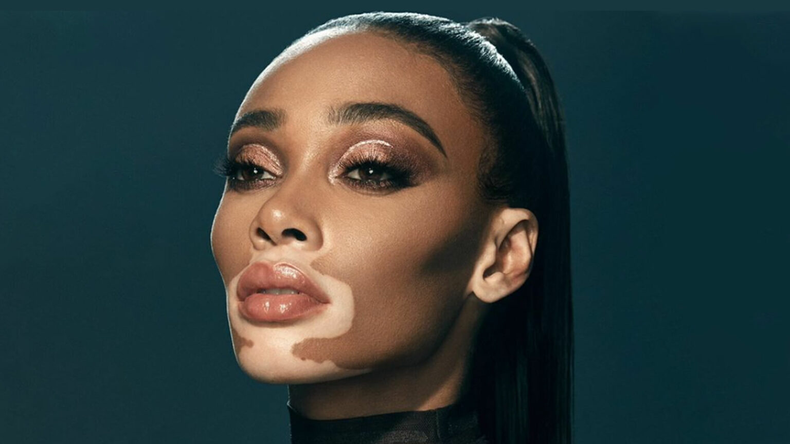 World Vitiligo Day: Learn everything there is to know about the disorder - Asiana Times