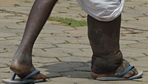 https://healthmd.net/elephantiasis-facts-symptoms-causes-treatment/