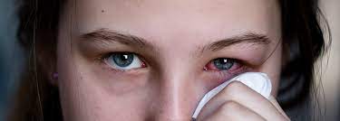 5 Causes Why sudden spike in Conjunctivitis? - Asiana Times