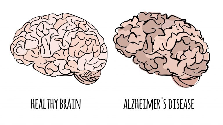 Difference between healthy brain and alzheimer's brain