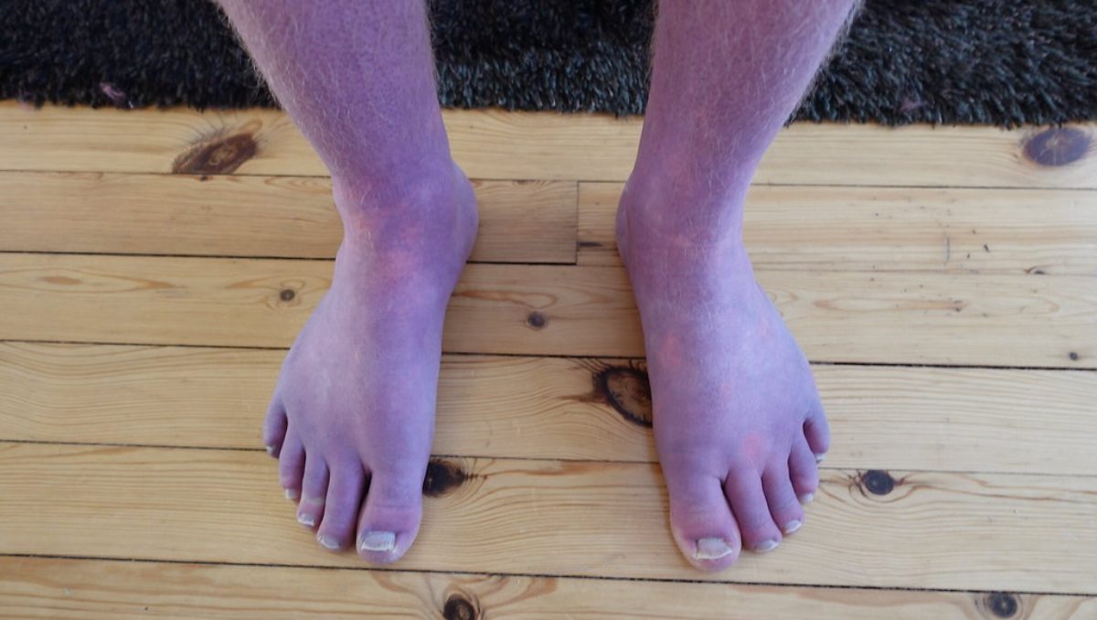 Unveiling Acrocyanosis (Blue legs): Unusual Long COVID Symptom Sparks Concern