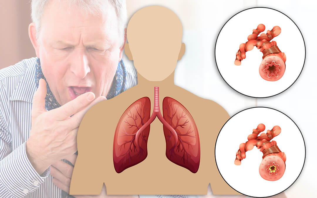 COPD in Older males were more common previously