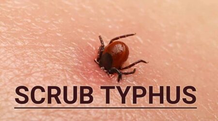 Scrub Typhus Takes Life Of Another Solan Patient - Asiana Times