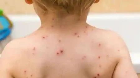 Clade 9: The New Chickenpox Virus Detected In India - Asiana Times