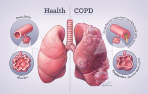 Sharp Rise In COPD Hospitalizations Are Occurring In Canada  - Asiana Times