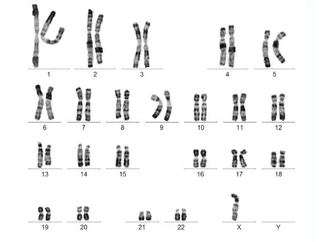 Y-chromosome Loss in Men Correlates With Adverse Cancer Results - Asiana Times