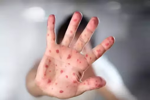 Clade 9: The New Chickenpox Virus Detected In India - Asiana Times