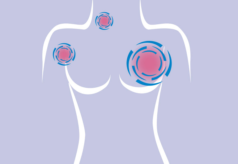 Breast and Colorectal Cancer are on the rise among Young Women