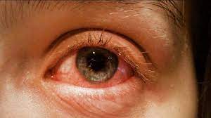 Conjunctivitis Outbreak in Delhi-NCR - Asiana Times