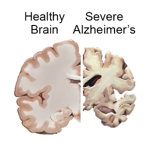 Healthy Brain vs Brain with severe Alzheimer