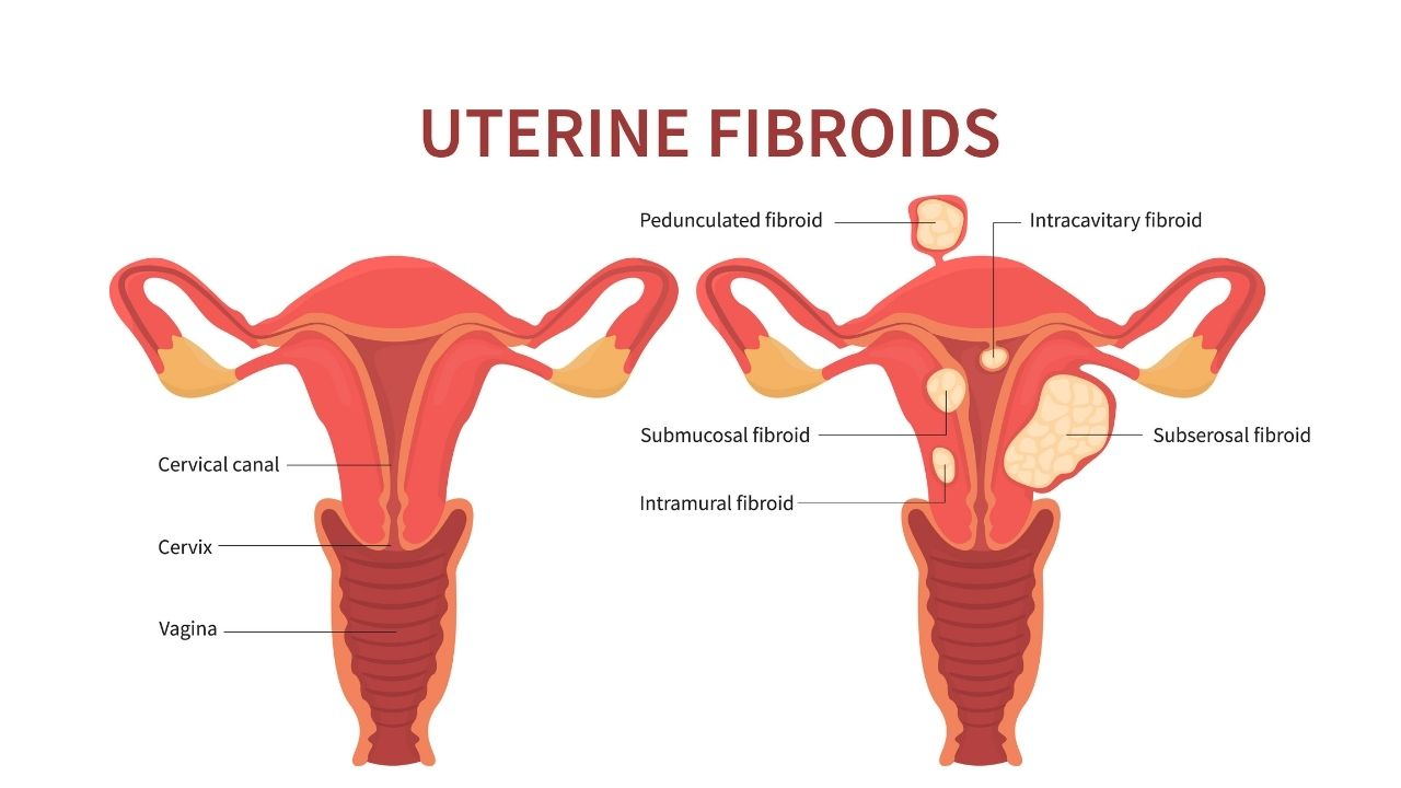 Watermelon-sized fibroid found in a pregnant woman - Asiana Times