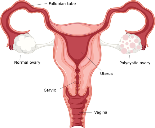 Normal ovary vs ovary with Polycystic Ovarian Syndrome
