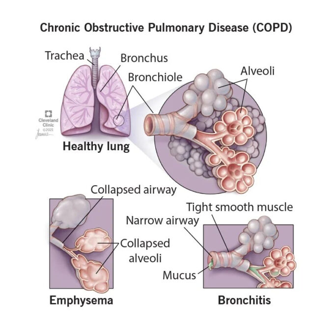 Sharp Rise In COPD Hospitalizations Are Occurring In Canada  - Asiana Times