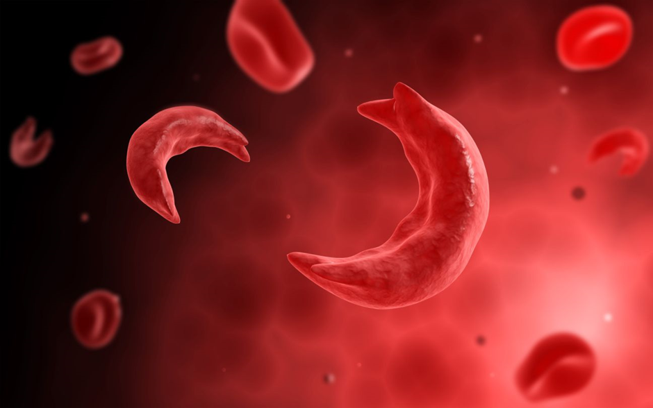 sickle cell anaemia

