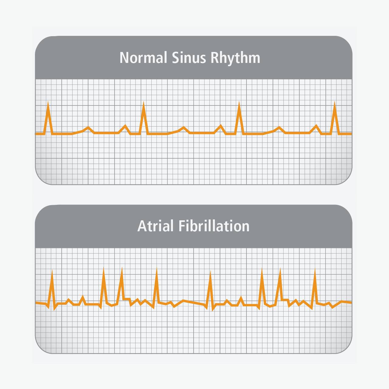 Normal Sinus Rhythm vs Atrial Fibrillation